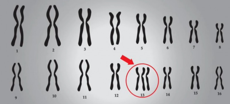 A Síndrome de Patau se caracteriza por uma trissomia no cromossomo 13 do DNA - (Reprodução/O Dia TV)