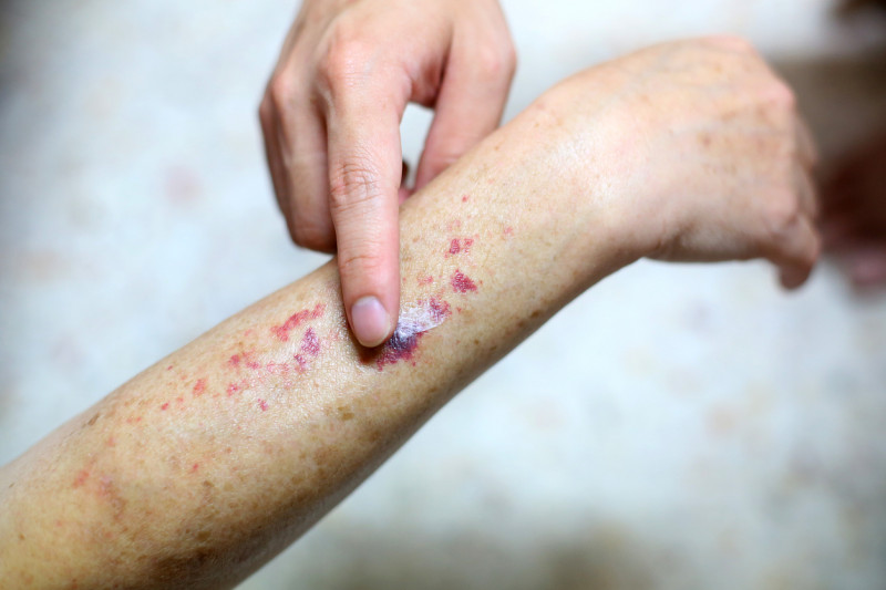 Sintomas de leucemia incluem manchas pelo corpo  - (Getty Images )