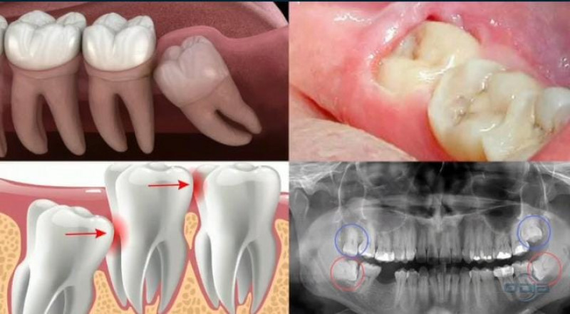 Dente Siso: entenda quando a extração é realmente necessária