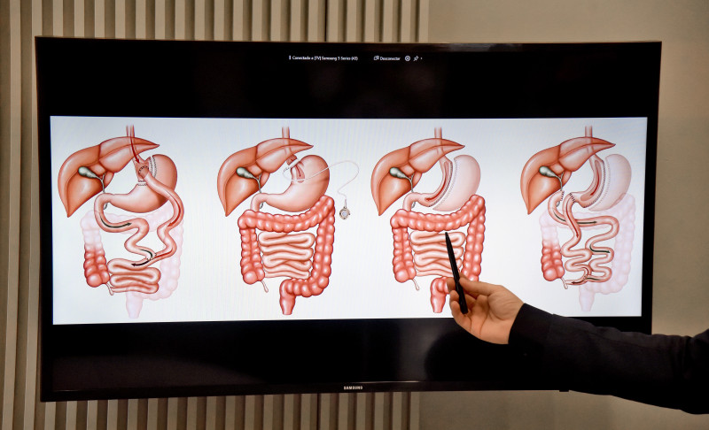 Dentre os procedimentos bariátricos mais comuns, duas se destacam: o sleeve e o bypass - (Assis Fernandes/O Dia)