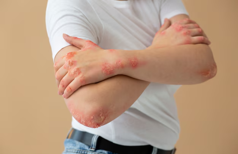 Sintomas da doença incluem manchas esbranquiçadas ou amareladas na pele,  - (Reprodução/Freepik)