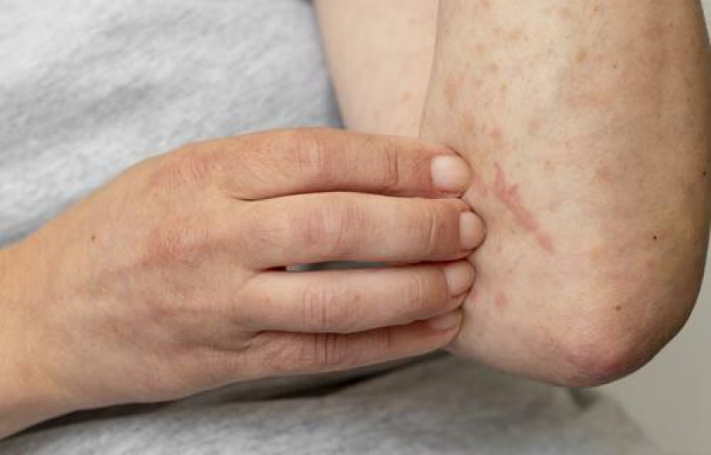 Sintomas de HPV incluem verrugas, lesões e alterações na pele - (Freepik)