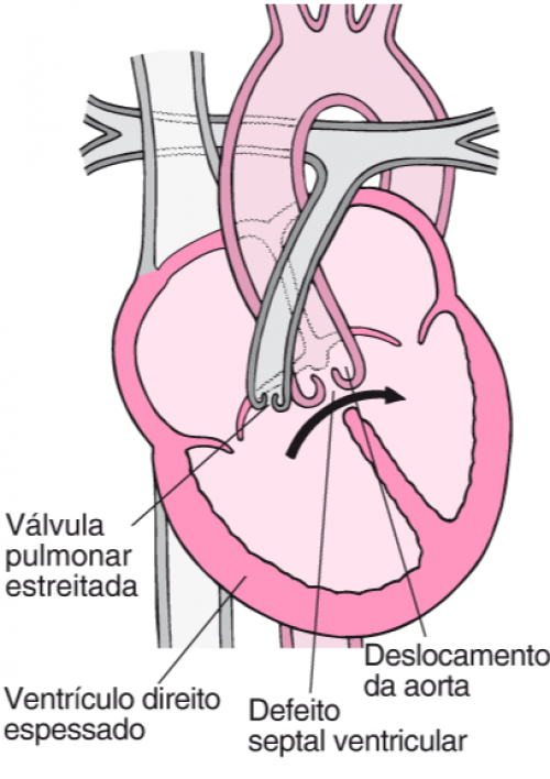 Tetralogia de Fallot é caracterizada por quatro malformações cardíacas - (Reprodução)