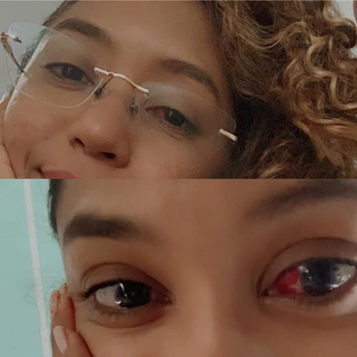Olhos de Moniquele se avermelharam após episódio - (Arquivo pessoal)