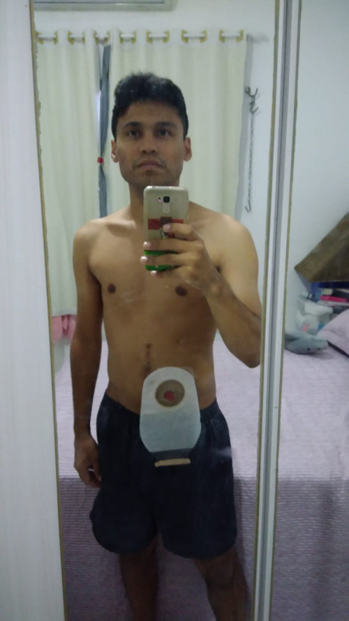 Marcos Vinicius foi diagnosticado com a doença de Crohn há 9 anos  - (Arquivo Pessoal)