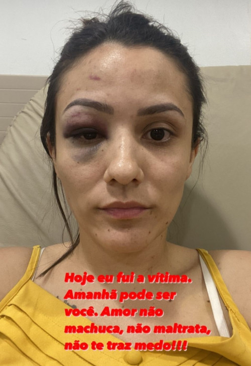 Carlene Nobre divulga fotos de rosto após agressão - (Reprodução/Instagram)