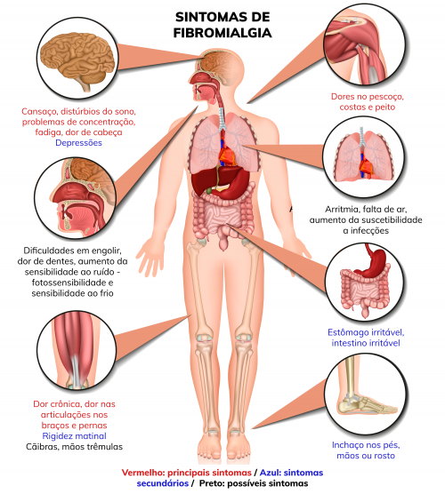 Sintomas da Fibromialgia - (Reprodução)