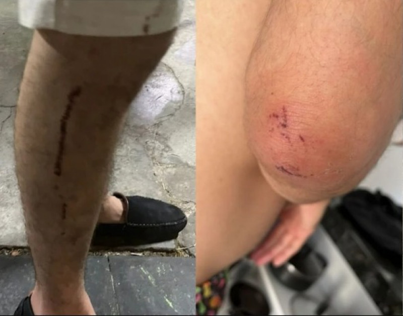 Estudante agredido em ataque homofóbico sofre fratura no cotovelo